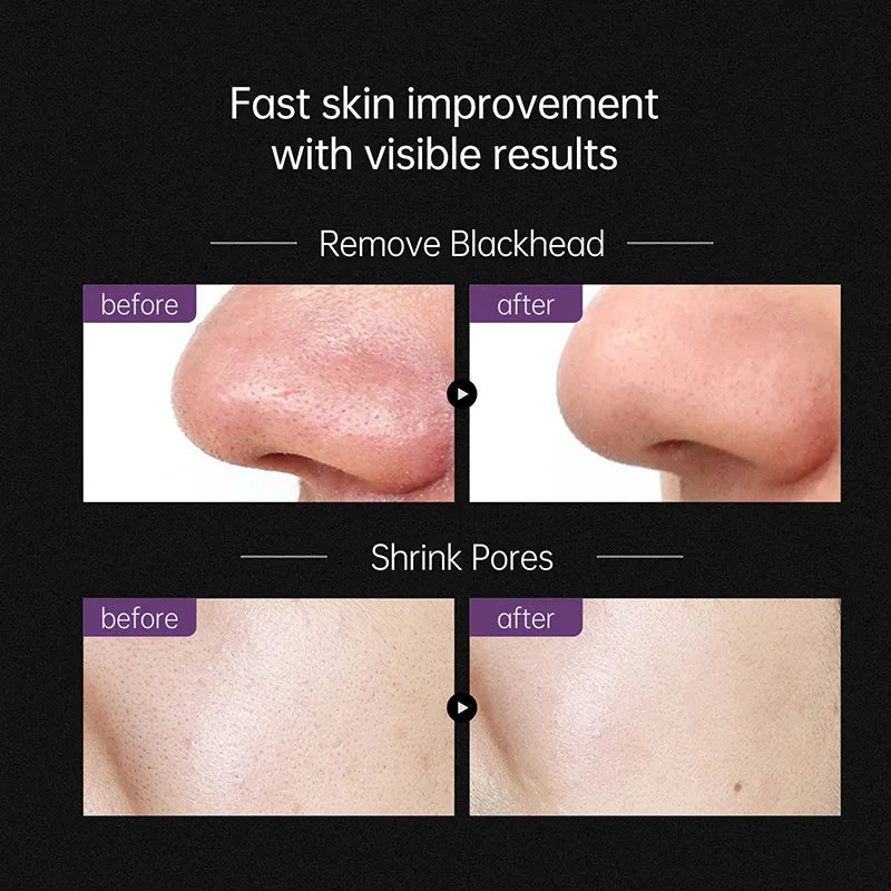 AUQUEST Facial Skin Care Mask For Removing Blackhead For a Healthier Skin l