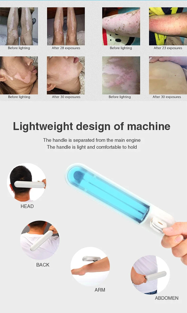 311NM UVB Phototherapy For Vitiligo Or Psoriasis Treatment At Home