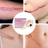 4x150cm Silicone Waterproof Self-Adhesive Scar Therapy Patch
