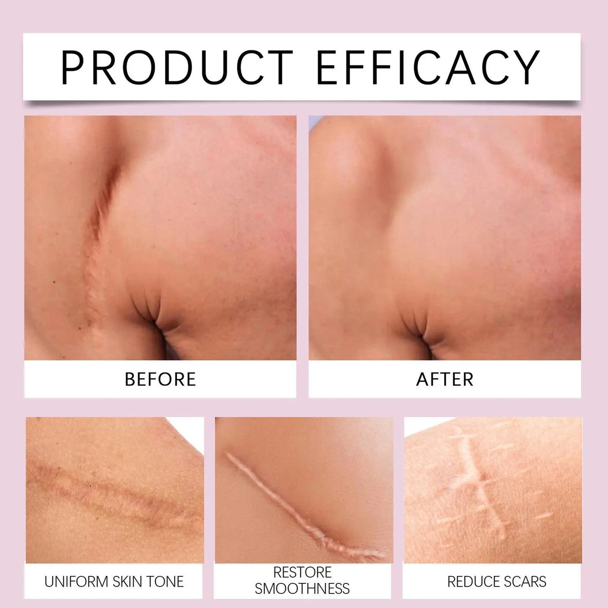 4x150cm Silicone Waterproof Self-Adhesive Scar Therapy Patch