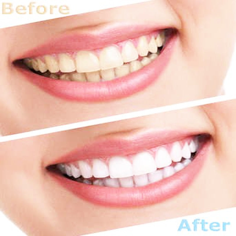 5pcs 5ML Teeth Whitening Peroxide Gel 10% 25% 35% Teeth Whitening Syringe hydrogen peroxide Gel